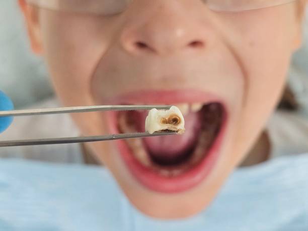 Best Emergency Dentist for Knocked-Out Tooth in Alvarado, TX